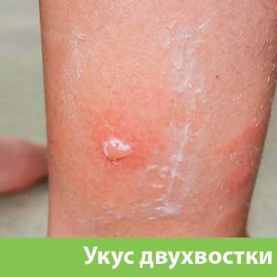 Укус двухвостки в Рубцовске