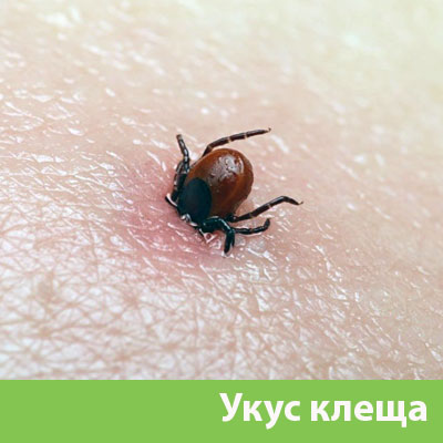 Укус клеща в Рубцовске