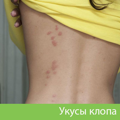 Профессиональное уничтожение клопов в Рубцовске